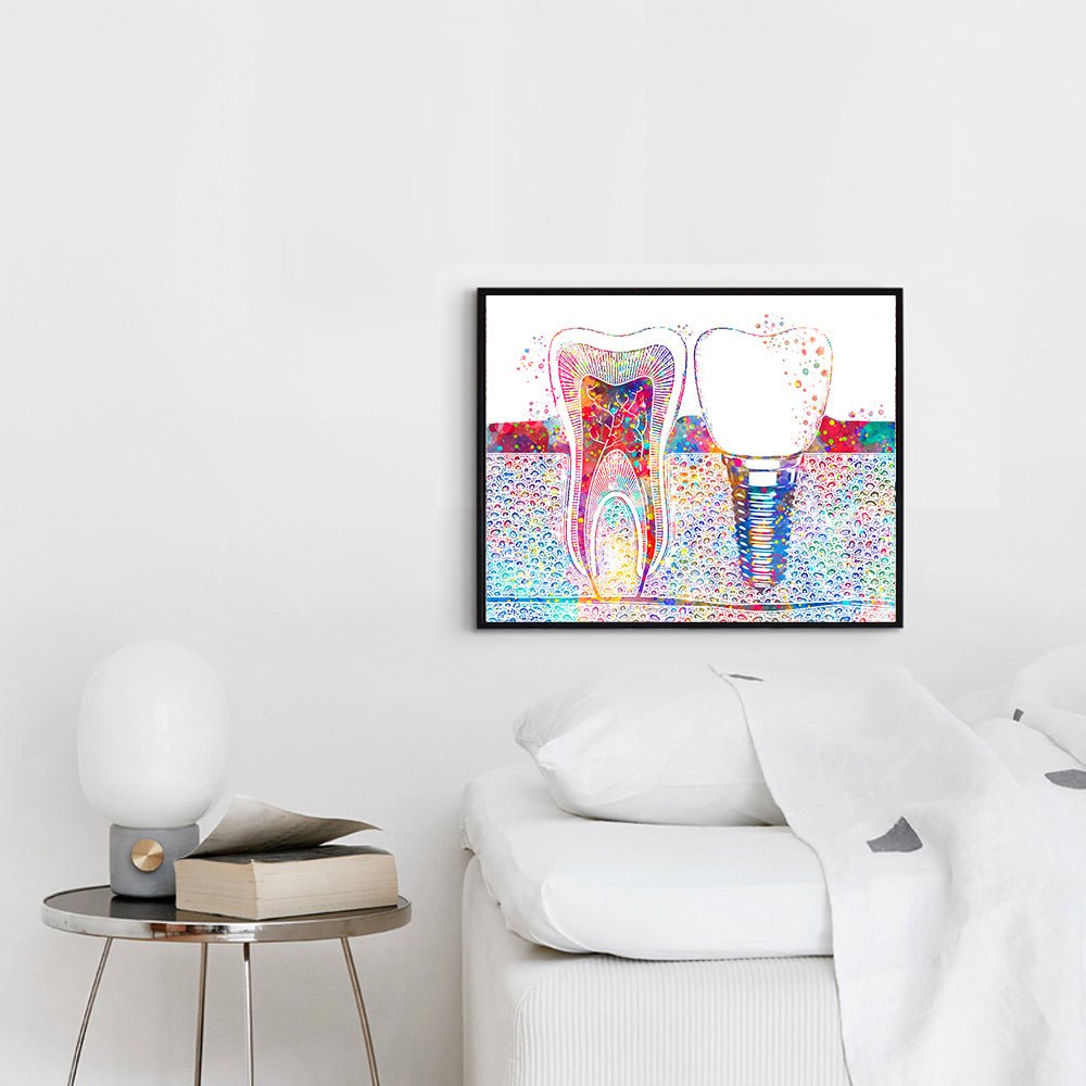 Tooth Implant Poster - Tooth Implant Wall Art Poster - Fir For Icons