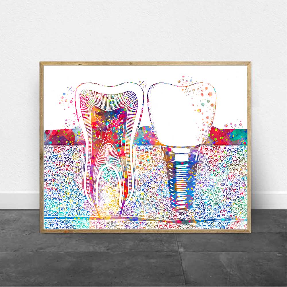 Tooth Implant Poster - Tooth Implant Wall Art Poster - Fir For Icons